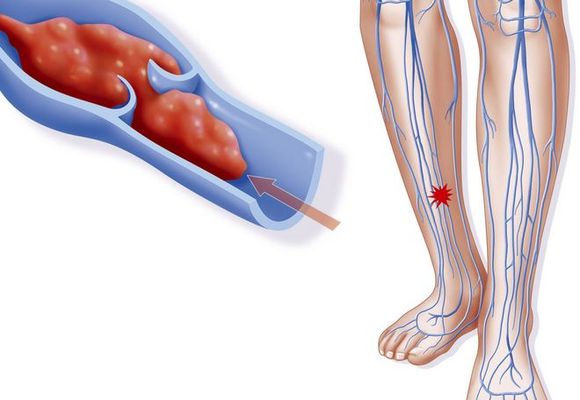 Vebinar: Prevencija venskog tromboembolizma